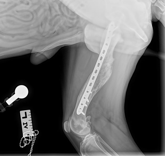 Healed comminuted femoral fracture